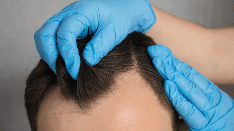 Haartransplantation ausland: Die Bedeutung der individuellen Beratung