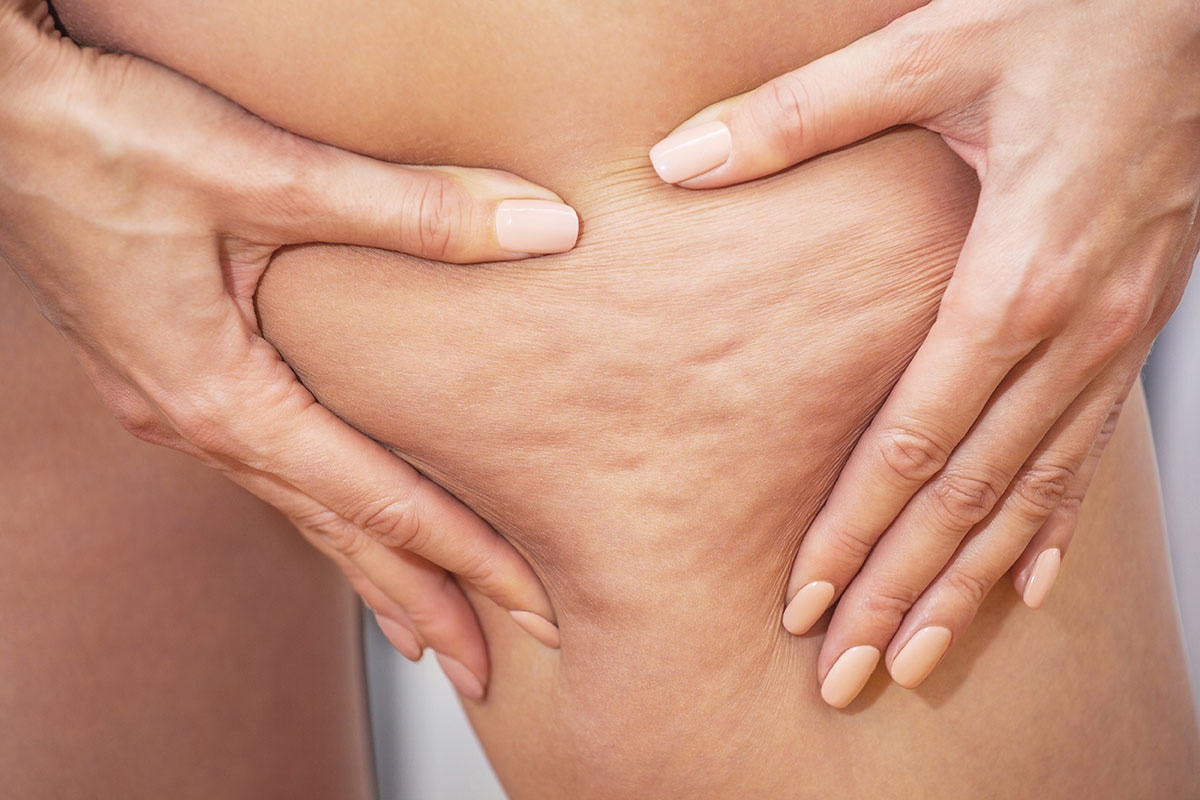 Lipödem verstehen: Ein umfassender Leitfaden zur Diagnose und Behandlung